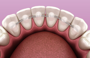Retainers dental installed after braces treatment, Medically accurate dental 3D illustration - obrazy, fototapety, plakaty