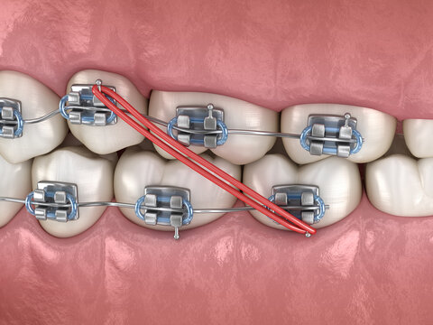 Elastics and metal braces for correction dental bite . Medically accurate dental 3D illustration