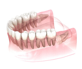 Horizontal impaction of Wisdom tooth. Medically accurate tooth 3D illustration