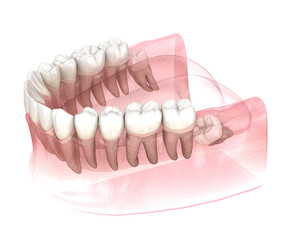 Mesial impaction of Wisdom tooth. Medically accurate tooth 3D illustration