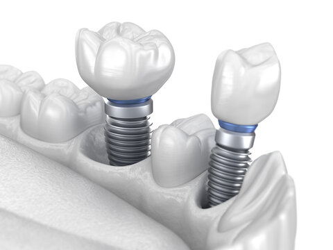 Premolar and Molar tooth crown installation over implant - white concept. 3D illustration of human teeth and dentures