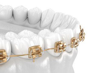 Healthy Teeth with gold braces, white teeth concept, dental 3D illustration