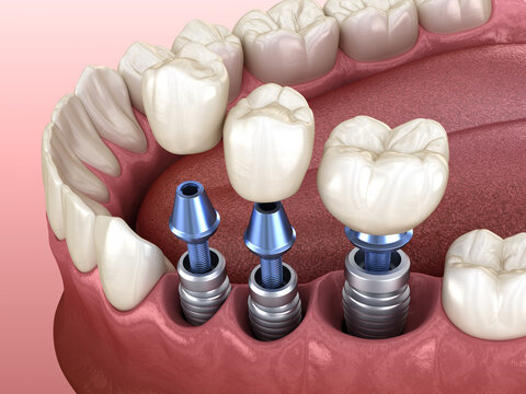 3 tooth crowns placement over 3 implants - concept. 3D illustration of human teeth and dentures