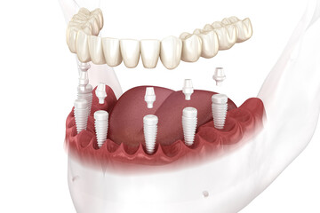 Removable mandibular prosthesis all on 6 system supported by ceramic implants. Medically accurate 3D illustration of human teeth and dentures