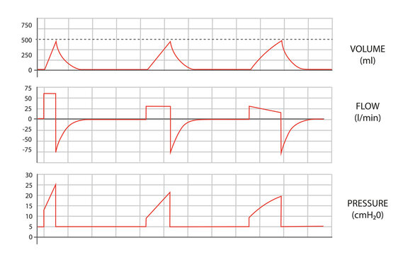 Mechanical Ventilation waves. Volume, flow and pressure curves from a mechanical Ventilator. 