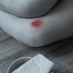 Fototapeta premium Black and white photo of big painful wound on female knee