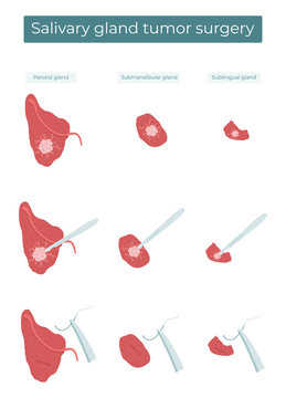 Vector flat illustration of surgical removal of a tumor from the parotid, submandibular, and sublingual salivary glands.