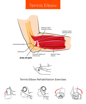 Vector illustration. Tennis Elbow and Tennis Elbow Rehabilitation Exercises 