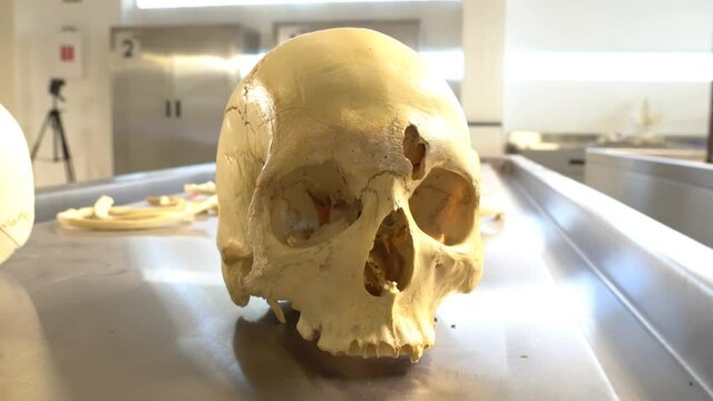 Human skull with a hole on the forehead.