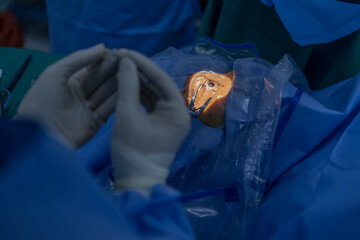Phacoemulsification, destruction of the opaque lens by ultrasound, ophthalmic eye surgery. eye lens...