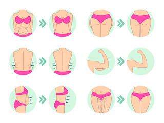 Obraz premium Liposuction. Liposuction hips, stomach. Removal of fat. Plastic surgery. Stock vector.