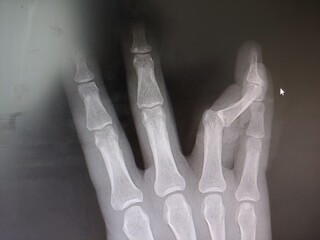 x ray of a hand