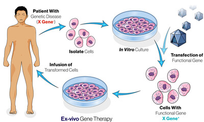 illustration of Ex vivo gene therapy in humans.