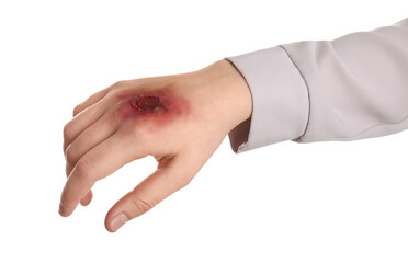 Woman with burned hand on white background, closeup