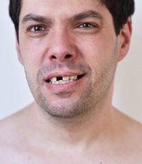 Fototapeta premium portrait of a man with broken teeth