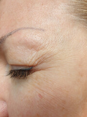 woman eyes wrinkles, aging skin