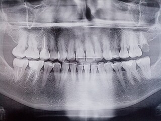 panoramic x-ray of human teeth