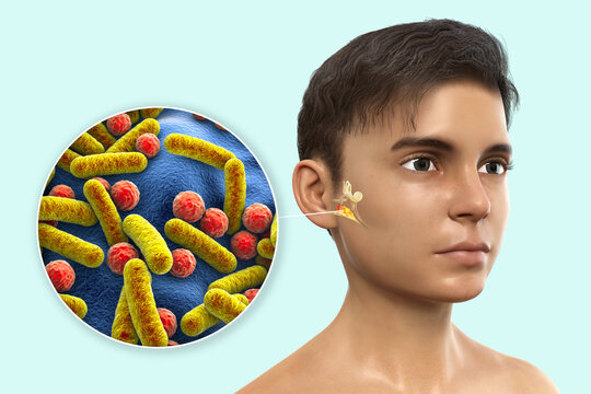 Otitis media, inflammatory disease of the middle ear