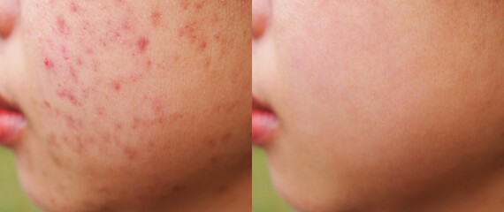 Image before and after acne treatment on the face of young Asian woman.Problem skin and beauty...