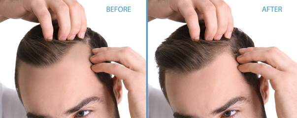 Closeup view of man before and after hair loss treatment on white background, collage. Banner design