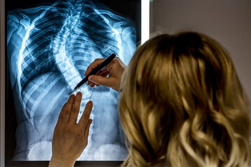 Blonde female physician looking at a patients x-ray. Scoliosis specialist Doctor making measurements at the patients X-Ray - obrazy, fototapety, plakaty