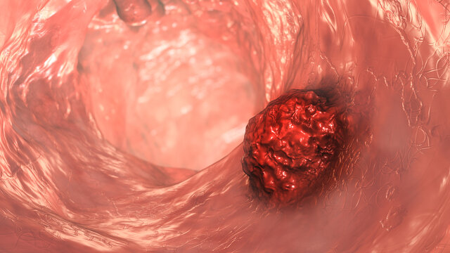 Intestinal carcinoma, colorectal cancer, bowel neoplasia, 3D illustration