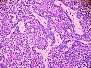 Benign skin tumor called eccrine spiradenoma. Microscopic view.