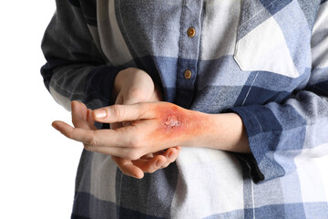 Woman with burn on her hand against white background, closeup
