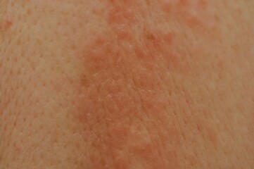 Fototapeta premium Eczema pimples on a back