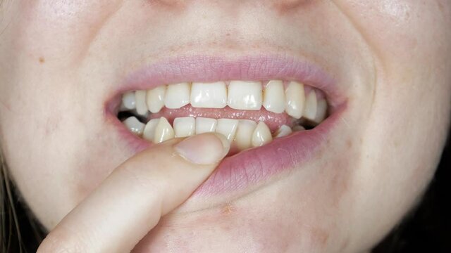 Crooked teeth in the woman's mouth. Dental decay and bad smile. Dentist treatment concept.