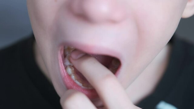 Baby tooth in mouth of a ten-year-old boy, he sways it with his finger, closeup view of open mouth. Change of teeth in a teenager. Stomatology, dentistry concept for child.