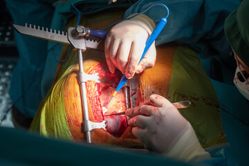 coronary artery bypass graft operation (CABG). Surgery for Coronary Artery Bypass Grafting: CABG....