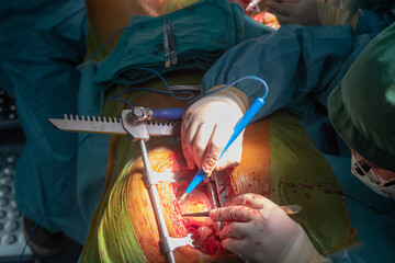 coronary artery bypass graft operation (CABG). Surgery for Coronary Artery Bypass Grafting: CABG....