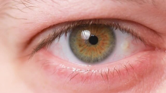 Pinguecula eyes macro video close-up of the male eye. Yellow education on squirrel, farmer's eye