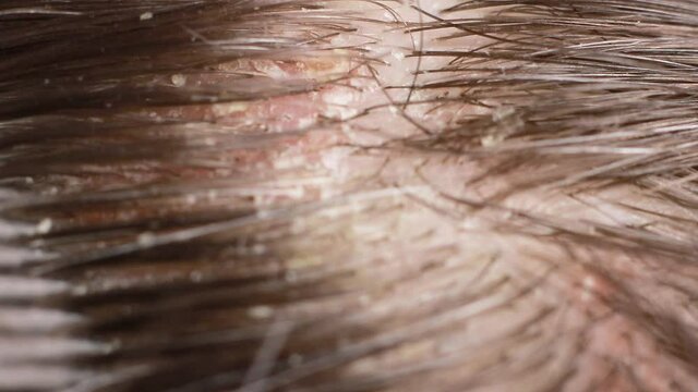 Macro video dander on dark brunette hair. The problem of dried scalp, wrong shampoo, fungus on the head