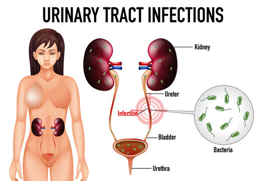 Information poster of urinary tract infections