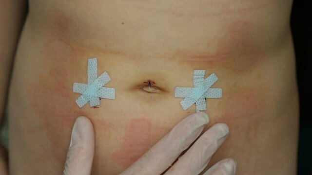 Inspection of surgical sutures on child's abdomen after surgery for inguinal and umbilical hernias.