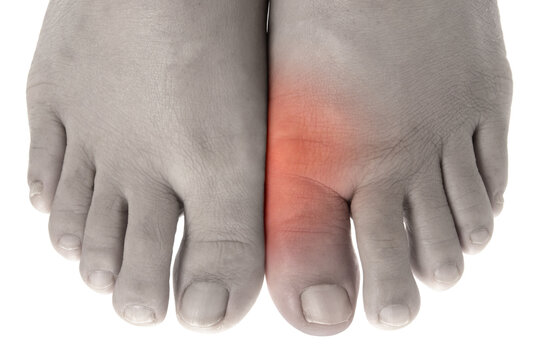 痛風症状の足の親指