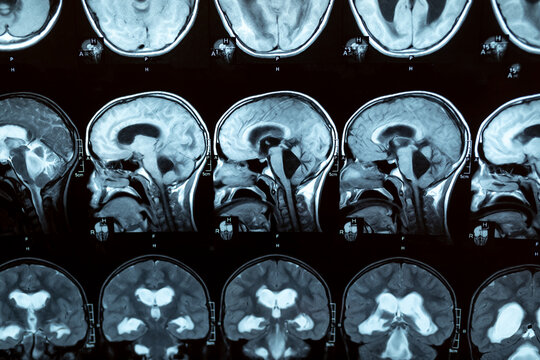 MRI scan or magnetic resonance image of the brain showed obstructive triventricular hydrocephalus with clinical of hydrocephalus, cognitive decline, incontinence. Neurology, medical service concept.