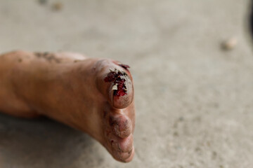 Focus is soft and blurry.The toe of the injured man, with a traumatic tear and bleeding, prevented the victim from standing up because of a foot injury and was waiting for emergency medical help.
