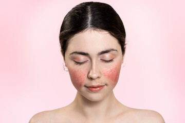 Portrait of a beautiful woman with her eyes closed, showing inflamed blood vessels on her cheeks....