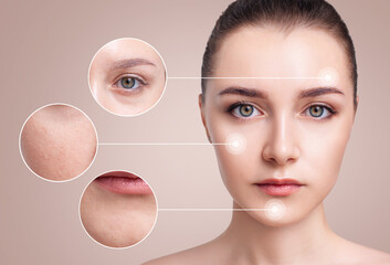 Face of young woman with zoom circles shows imperfections of skin.