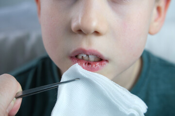 dentist, doctor examines oral cavity of small patient, lip burst, blood on the wound, molars grow, boy, kid with open mouth, close up of child’s mouth, teeth