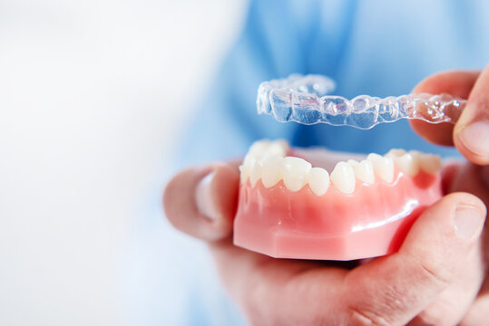 Close-up. The doctor puts transparent aligners on the teeth of the artificial jaw