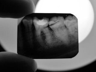 The result of x-ray radiography of the teeth of the oral cavity of the patient to be treated in...