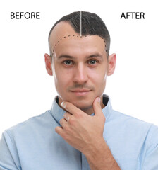 Man before and after hair loss treatment on white background, collage