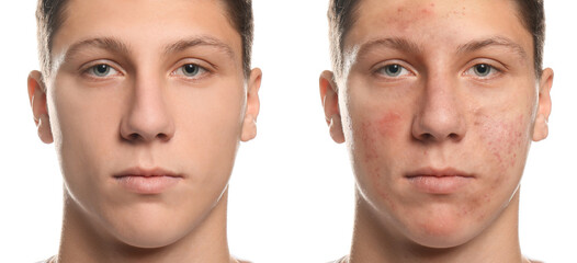 Collage with photos of teen guy with acne problem before and after treatment on white background....