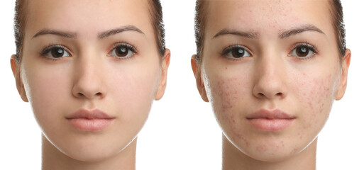 Collage with photos of teenage girl with acne problem before and after treatment on white...