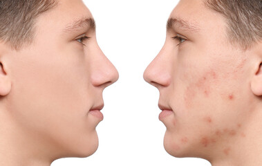 Obraz premium Collage with photos of teen guy with acne problem before and after treatment on white background