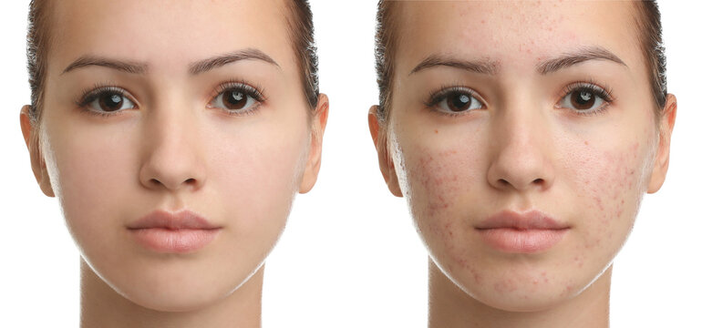 Collage with photos of teenage girl with acne problem before and after treatment on white background. Banner design